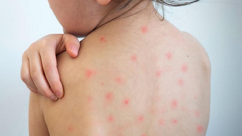 Measles cases rise in Sylhet; 4 patients confirmed